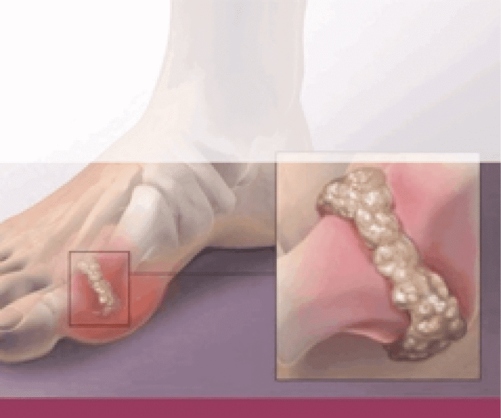 uric acid-Uric acid test